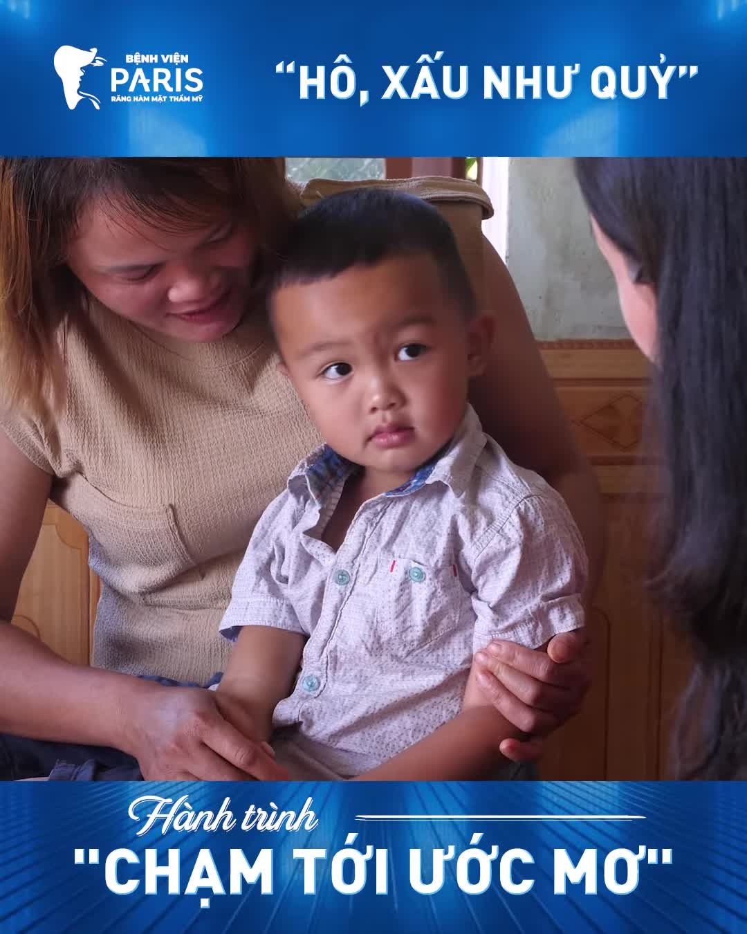 Phẫu thuật hàm hô 2 hàm