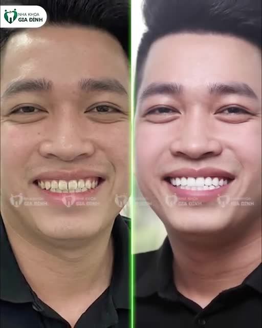 PHONG ĐỘ HƠN, HOÀN HẢO HƠN SAU KHI THẨM MỸ RĂNG SỨ