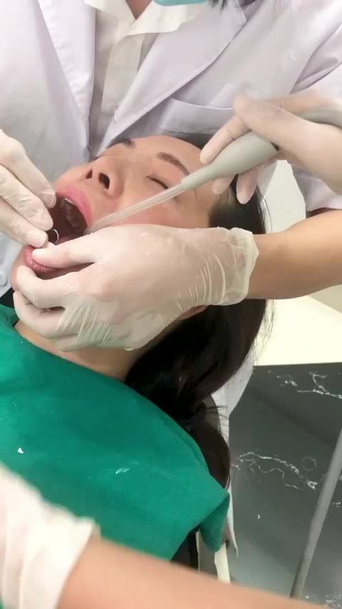 QUÁ TRÌNH DÁN 16 VENEER SỨ CAO CẤP CHO KHÁCH HÀNG HƯƠNG GIANG