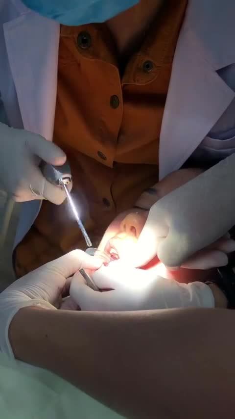 QUÁ TRÌNH DÁN SỨ VENEER CHO MỘT NỮ KHÁCH HÀNG XINH ĐẸP