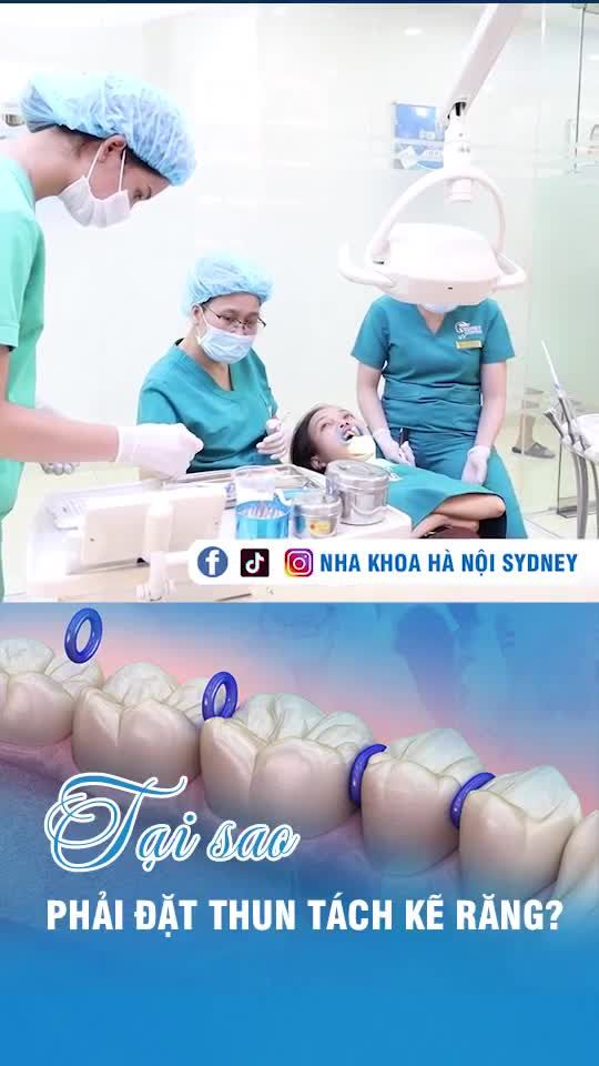 Tại sao phải đặt thun tách kẽ răng