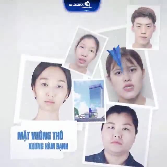 THON GỌN GÓC HÀM VĨNH VIỄN - VỚI CÔNG NGHỆ HÀN QUỐC 3D - GỌT CHỈNH HÀM
