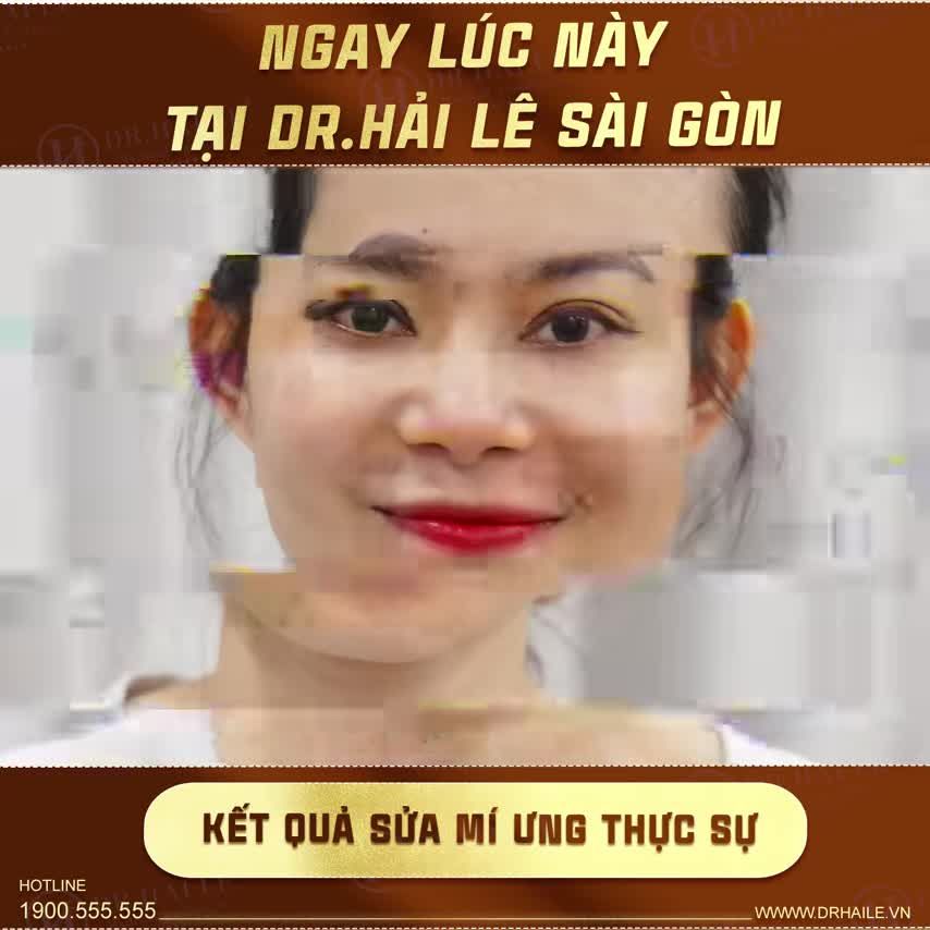 Tin được không đây chính là kết quả sau khi vừa thực hiện sửa mí tại Dr.Hải Lê-Sài Gòn. ĐẸP QUÁ TRỜI