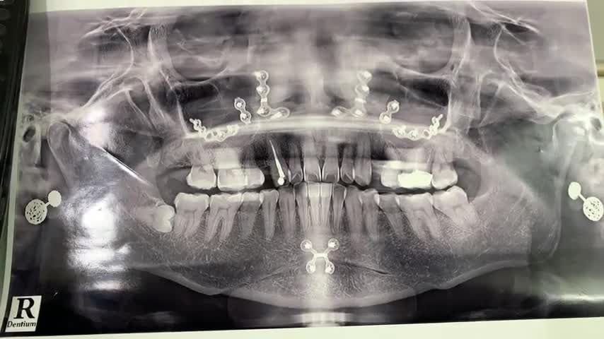 Trồng chân răng nhân tạo implant khôi phục lại răng 24 cho chị khách hàng tại Nha Khoa Thuỳ Anh cơ sở TP. Phổ Yên