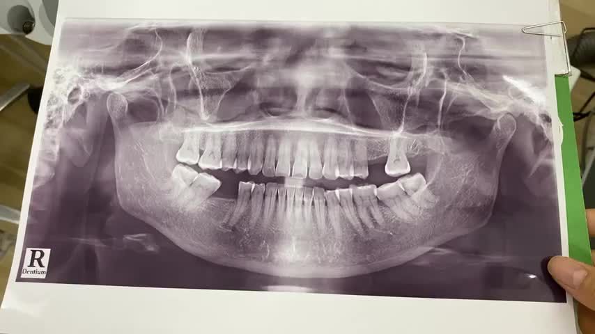 Trồng răng implant số 46 cho cô Vẹn tại Nha Khoa Thuỳ Anh cơ sở tp. Thái Nguyên.