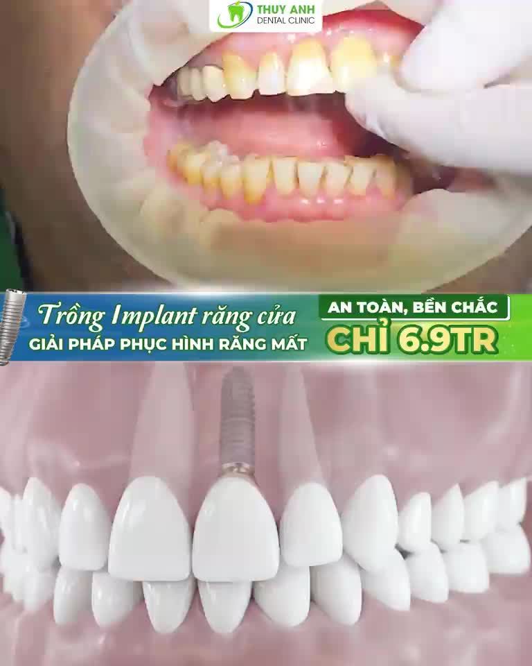 TRỒNG RĂNG IMPLANT TẶNG NGAY MÃO SỨ MỸ