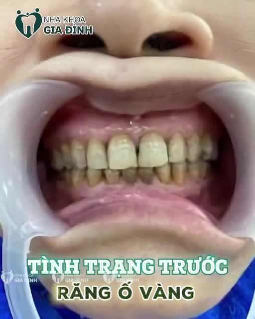 VẺ ĐẸP THÁCH THỨC TUỔI TÁC CÙNG RĂNG SỨ THẨM MỸ