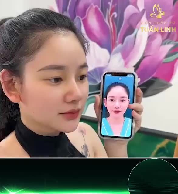 Cùng ngắm nhìn dáng mũi tái cấu trúc ( mũi sửa lại) bọc megaderm toàn sống sau 10 ngày phẫu thuật.