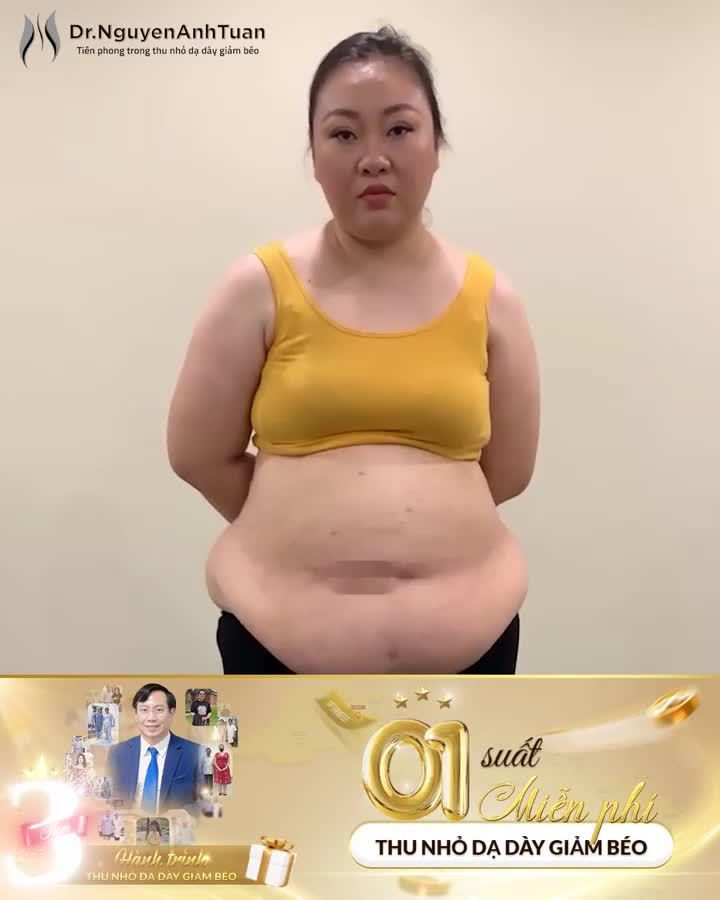 Sự kiện Kỷ niệm 3 năm hành trình thu nhỏ dạ dày giảm béo đã đến gần.