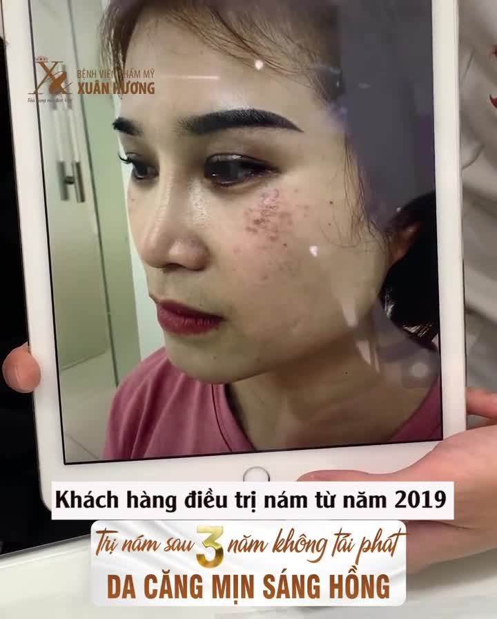 TRỊ NÁM SAU 3 NĂM DA VẪN ĐẸP CĂNG MỊN, MINH CHỨNG CHO CÔNG NGHỆ HIỆN ĐẠI CÙNG PHÁC ĐỒ HIỆU QUẢ TẠI XUÂN HƯƠNG