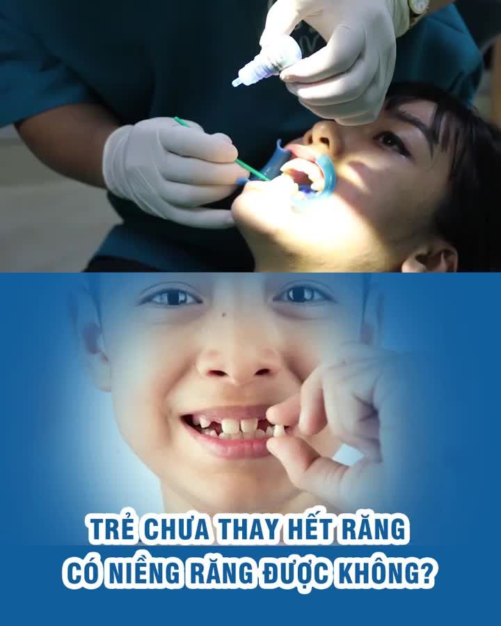 Trẻ chưa thay hết răng có niềng răng được không?