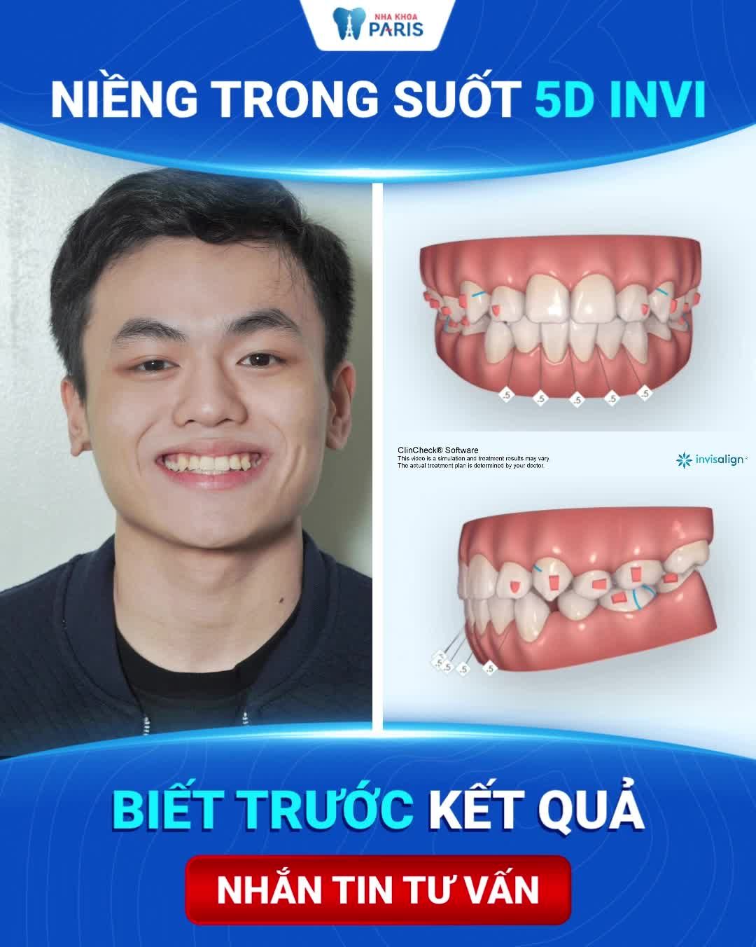 HẾT LO LẮNG RĂNG CHẠY LẠI SAU NIỀNG RĂNG