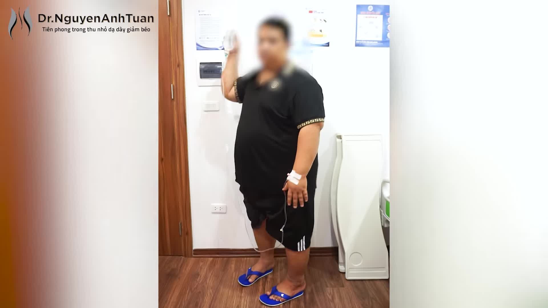 Sau 9 năm chiến đấu với căn bệnh béo phì, nam bệnh nhân của chúng tôi đã quyết định thực hiện thu nhỏ dạ dày