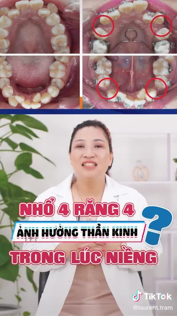 NHỔ 4 RĂNG 4 TRONG LÚC NIỀNG CÓ ẢNH HƯỞNG THẦN KINH KHÔNG ?