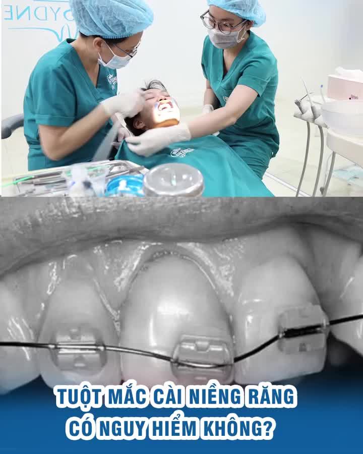 Tuột mắc cài niềng răng có nguy hiểm không?