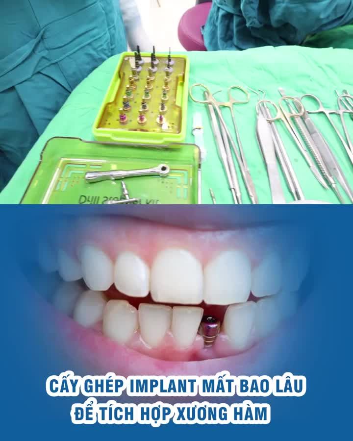 Cấy ghép implant mất bao lâu để tích hợp xương hàm?
