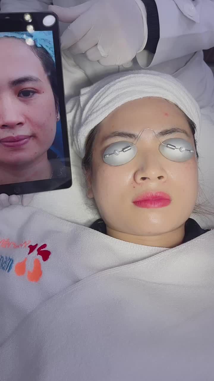 kết quả điều trị nám, tàn nhang với công nghệ Laser Picosure tại Kangnam