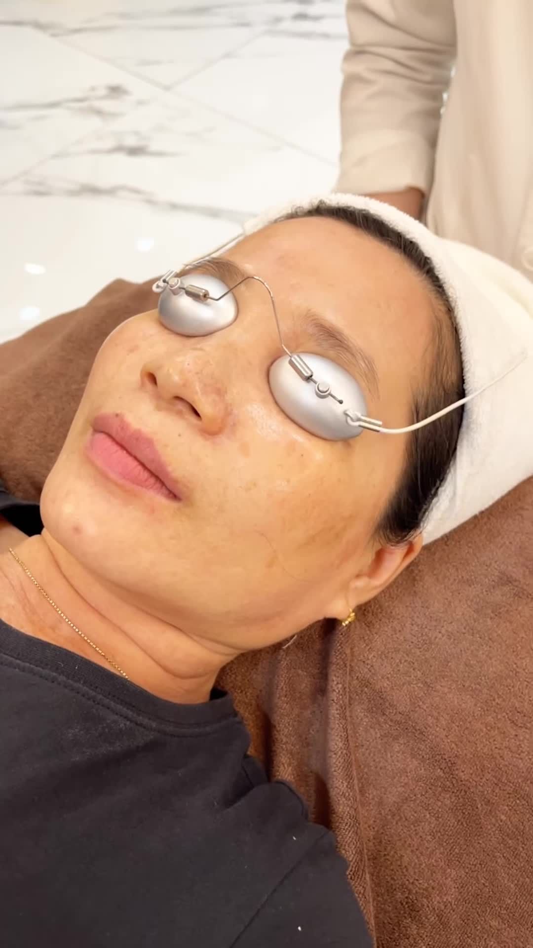 Điều trị Nám hiệu quả cùng Kangnam!