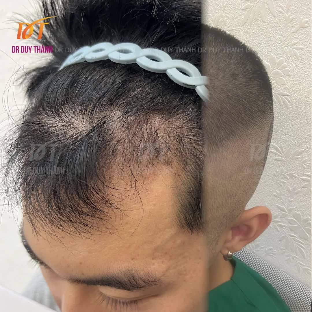 3 tháng 14 ngày sau cấy tóc. Giai đoạn sớm của quá trình mọc tóc cấy.