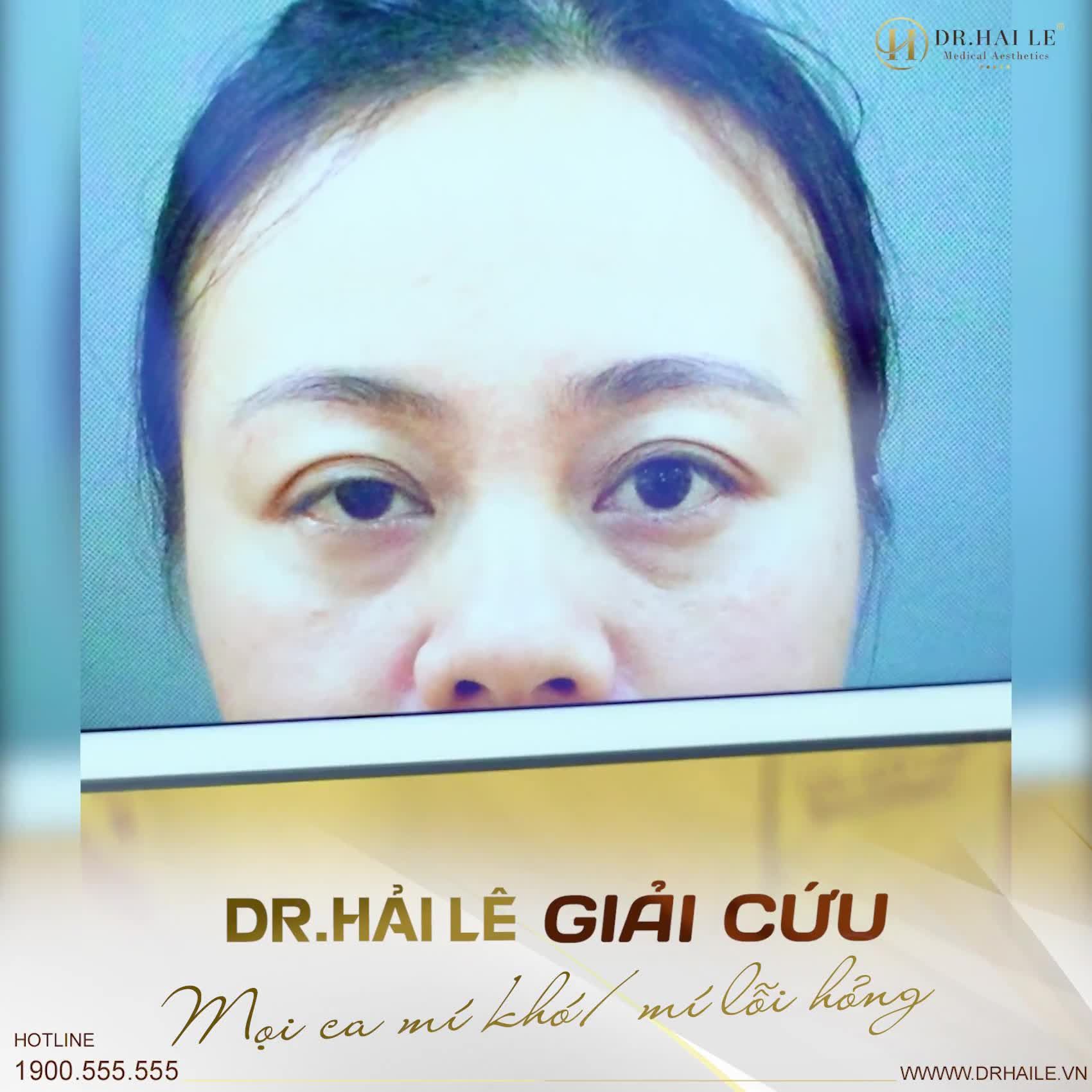 Điều gì tạo nên sự khác biệt của thương hiệu Thẩm mỹ mắt Dr.Hải Lê