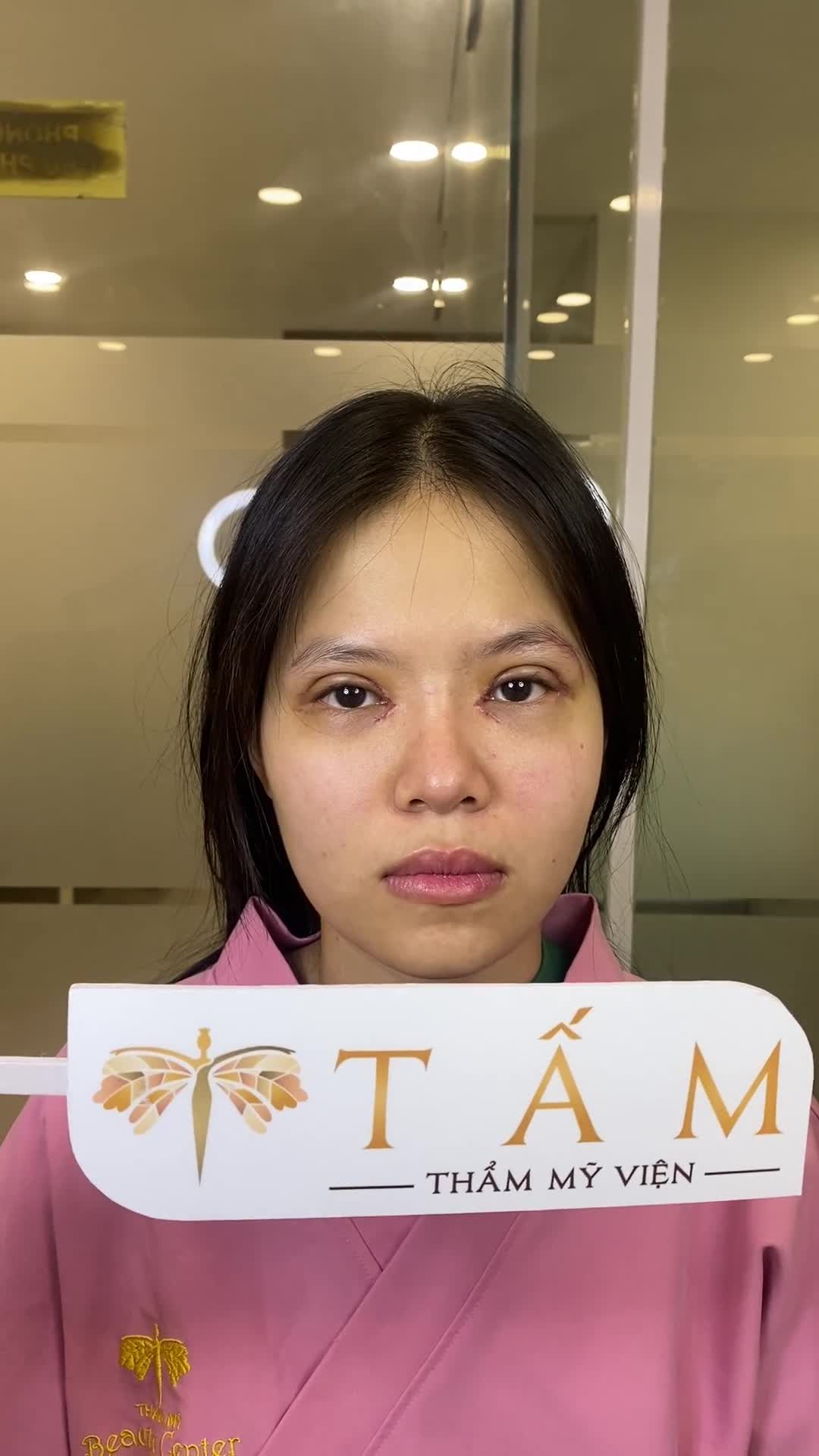 Khách hàng tới cắt chỉ sau 6 ngày thực hiện combo Cắt mí trên + Mở góc mắt. Mọi người cùng theo dõi nhé!