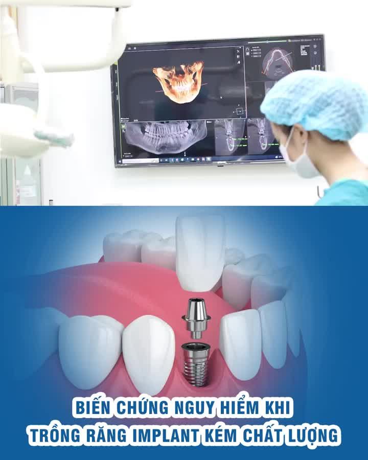 Biến chứng nguy hiểm khi trồng răng Implant kém chất lượng