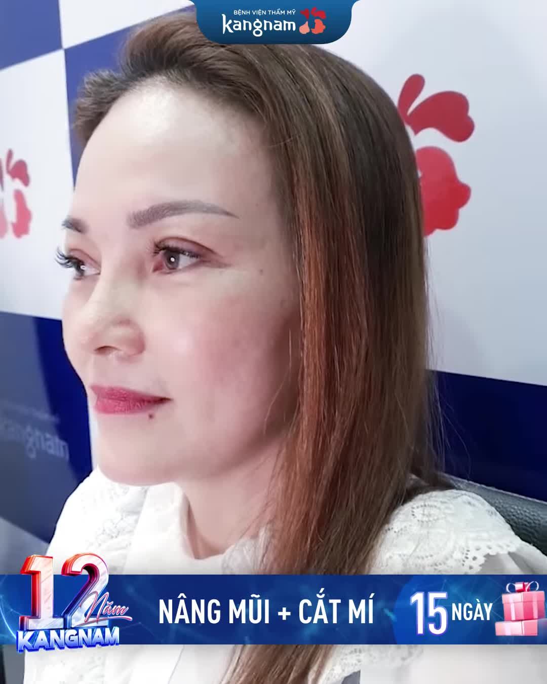 Thăng hạng nhan sắc sau combo Nâng mũi và cắt mí