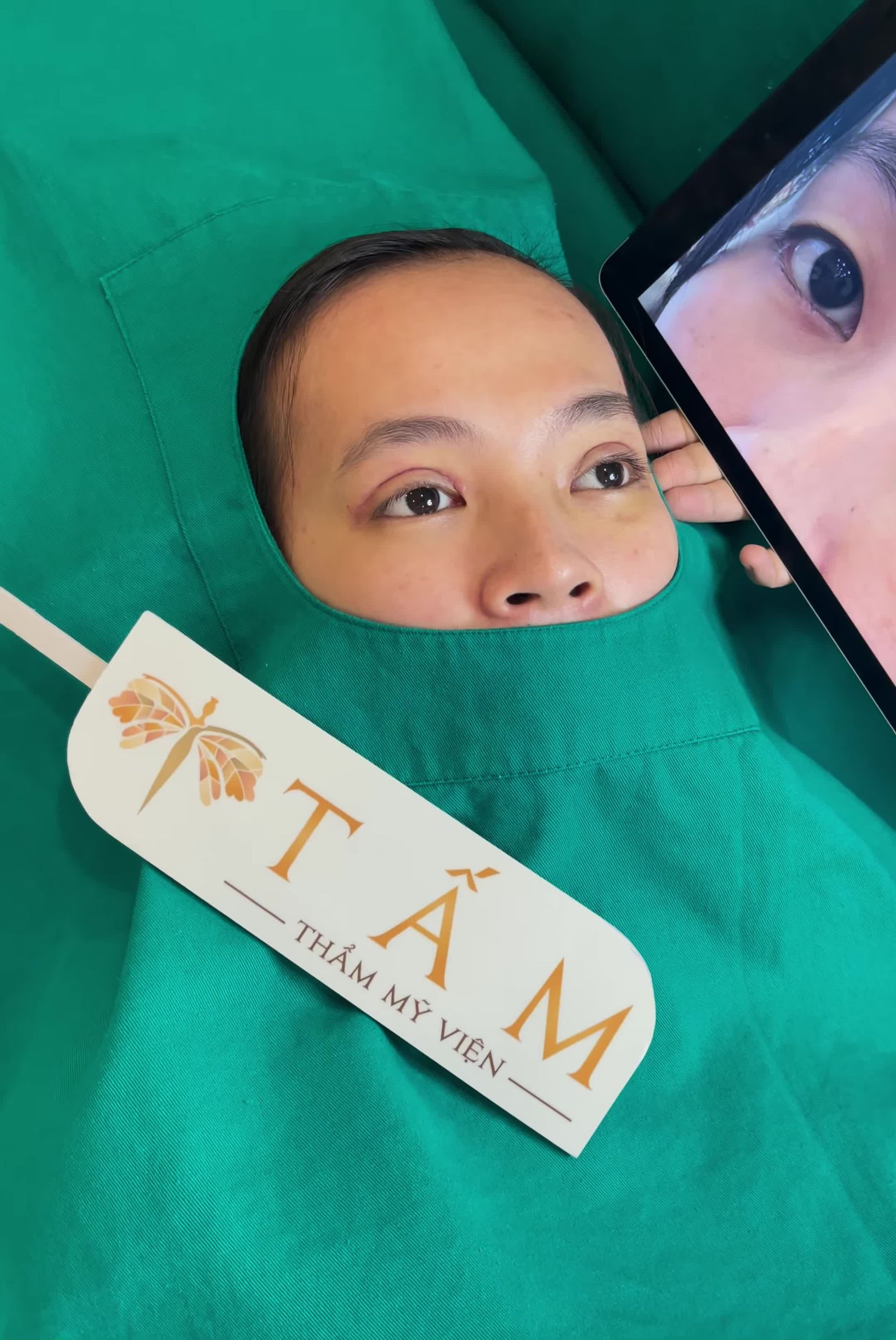 Kết quả sau 6 ngày thực hiện ca cắt mí Line Mini tại TMV Tấm, các nàng thấy mờ ê chưa ạ Đến #Tấm ngay để trở nên xinh đẹp các nàng nha!!