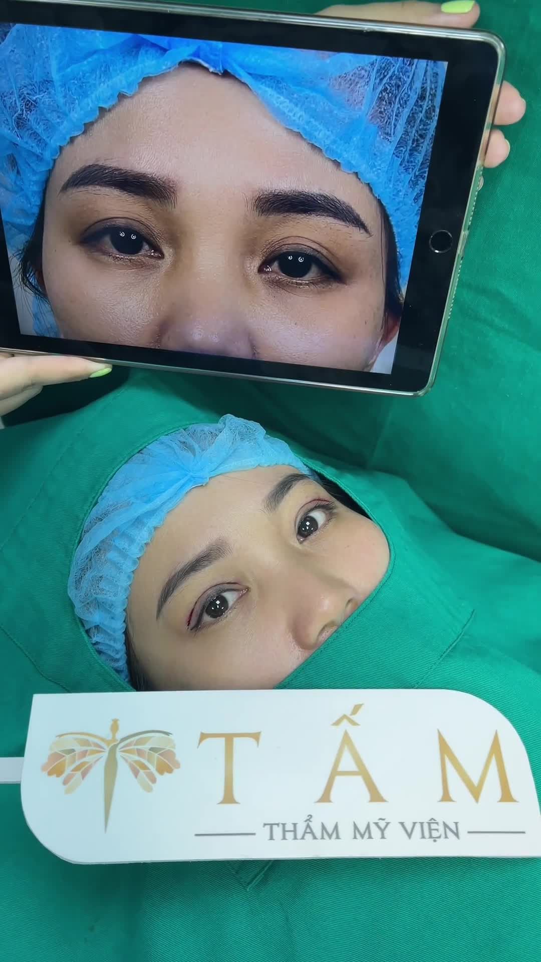 Sau 45 phút làm Combo Cắt mí + Cấy mỡ tại Tấm. Mọi người cùng xem hình ảnh ngay sau làm nhé!