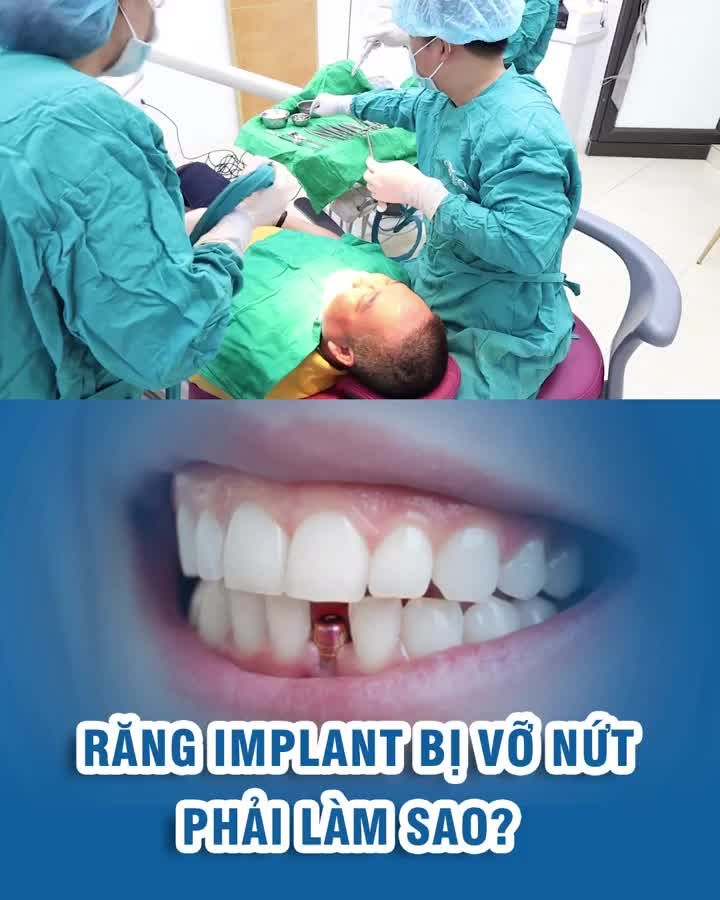Răng Implant bị vỡ nứt phải làm sao? Cách khắc phục