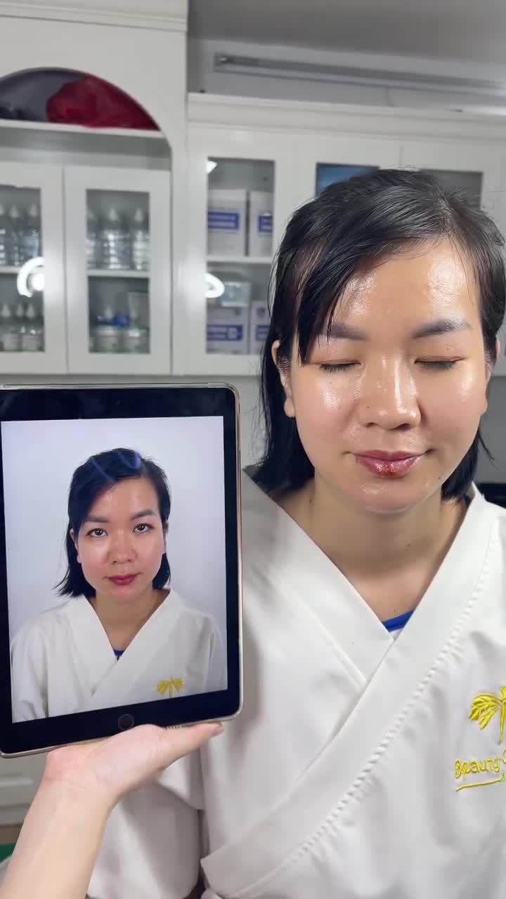 Ca tái khám Vline Perfect thon gọn hàm TMV Tấm
