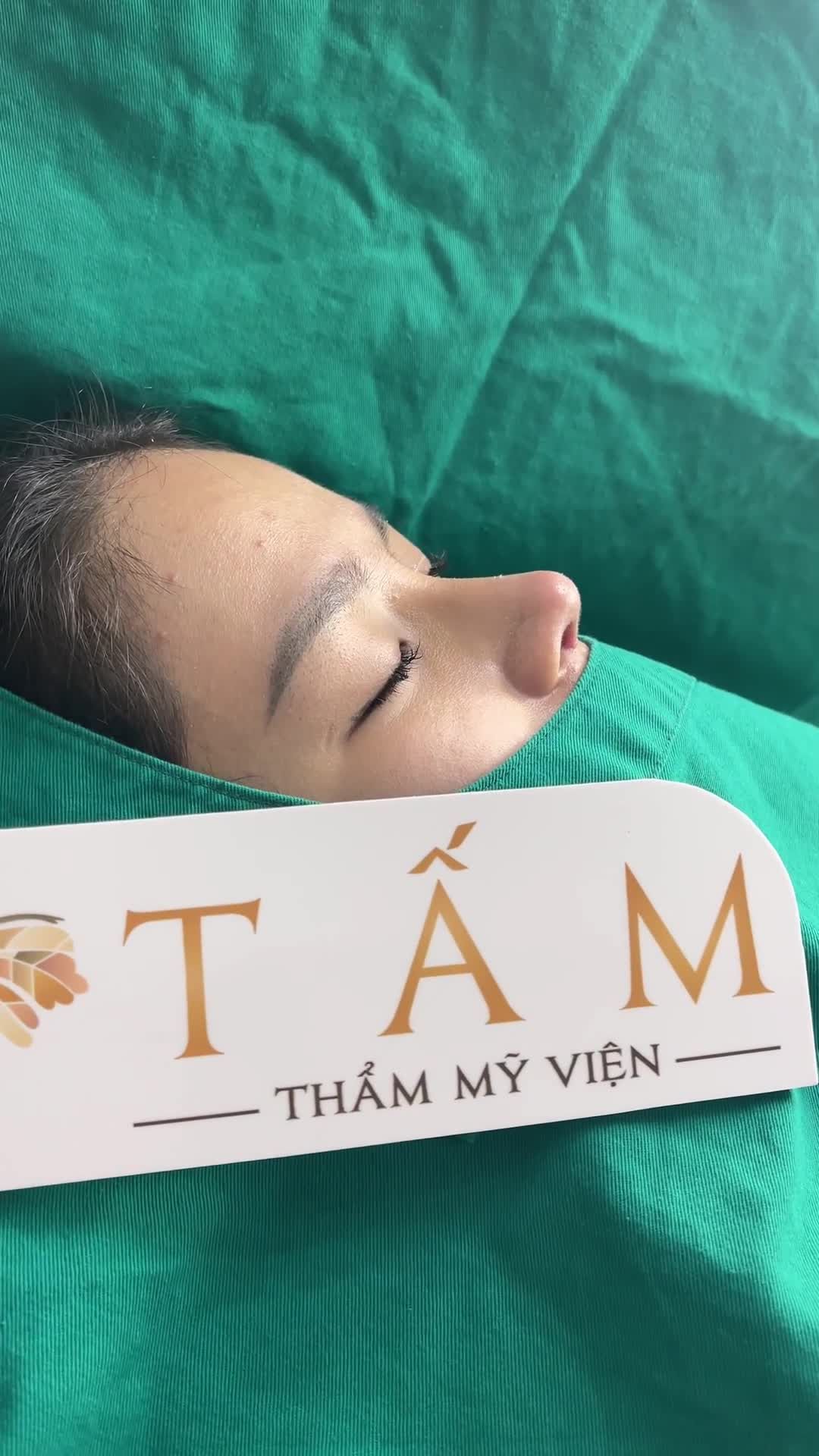 Mũi sau tháo nẹp Có ai mê mẩn dáng mũi tại TMV Tấm không