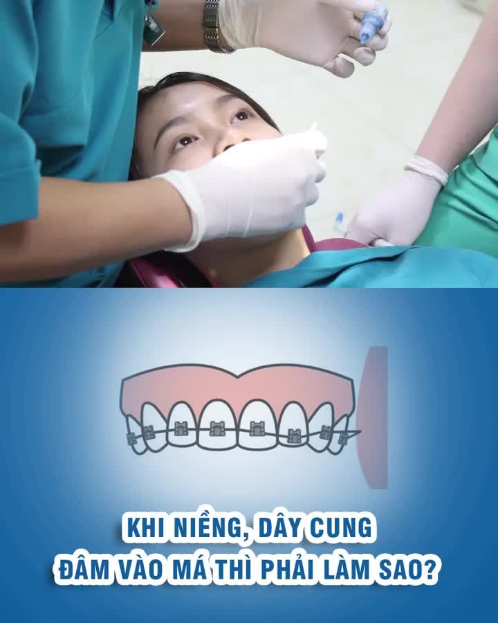 Khi niềng, dây cung đâm vào má thì phải làm sao?