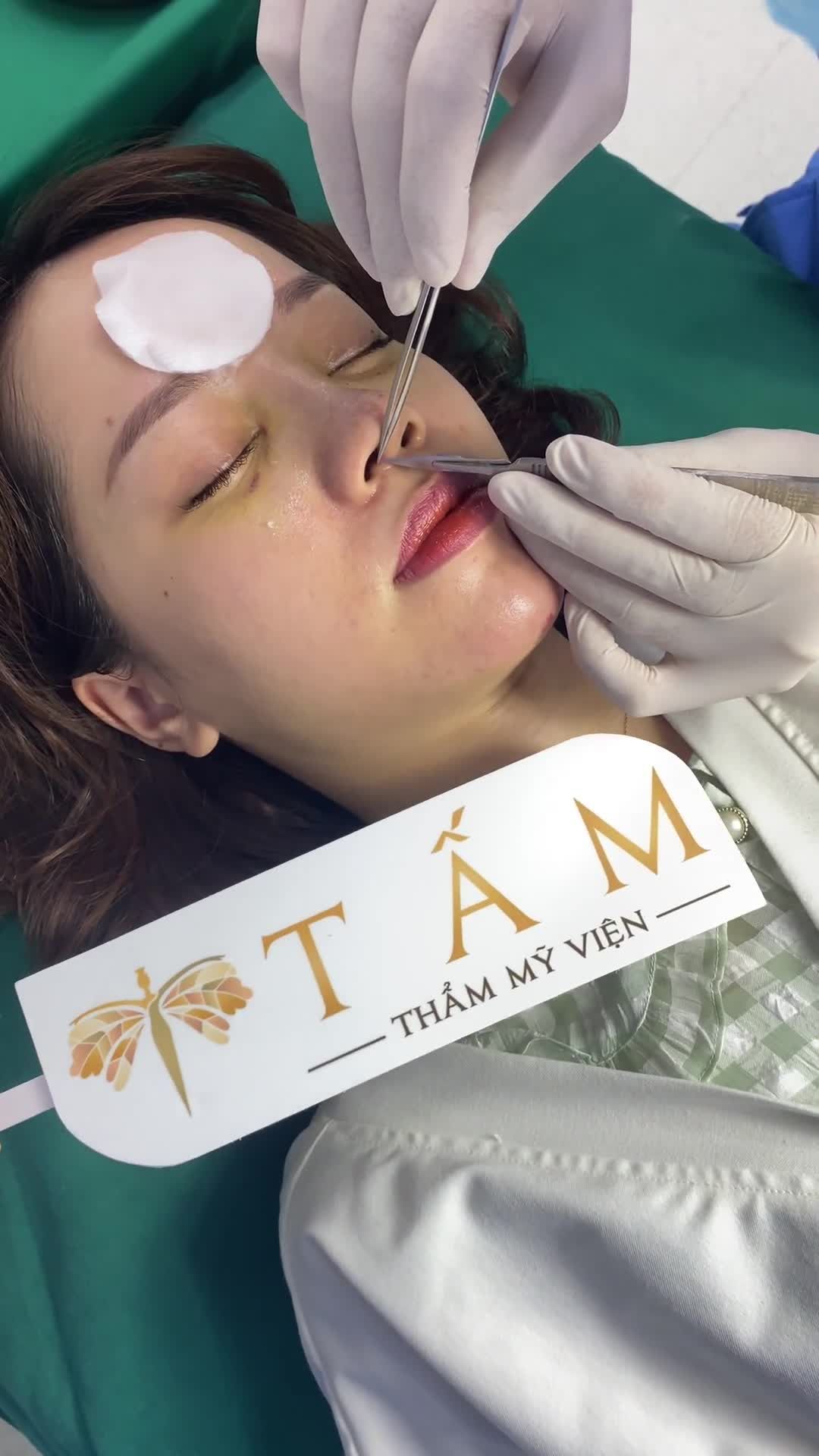 Mời cả nhà theo dõi quá trình cắt chỉ mũi vô cùng nhẹ nhàng và ngắm dáng mũi 10 ngày tuổi của chị khách