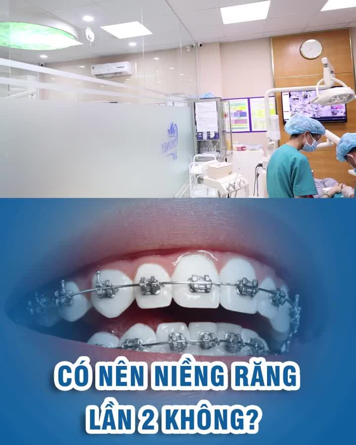Có nên niềng răng lần 2 không?