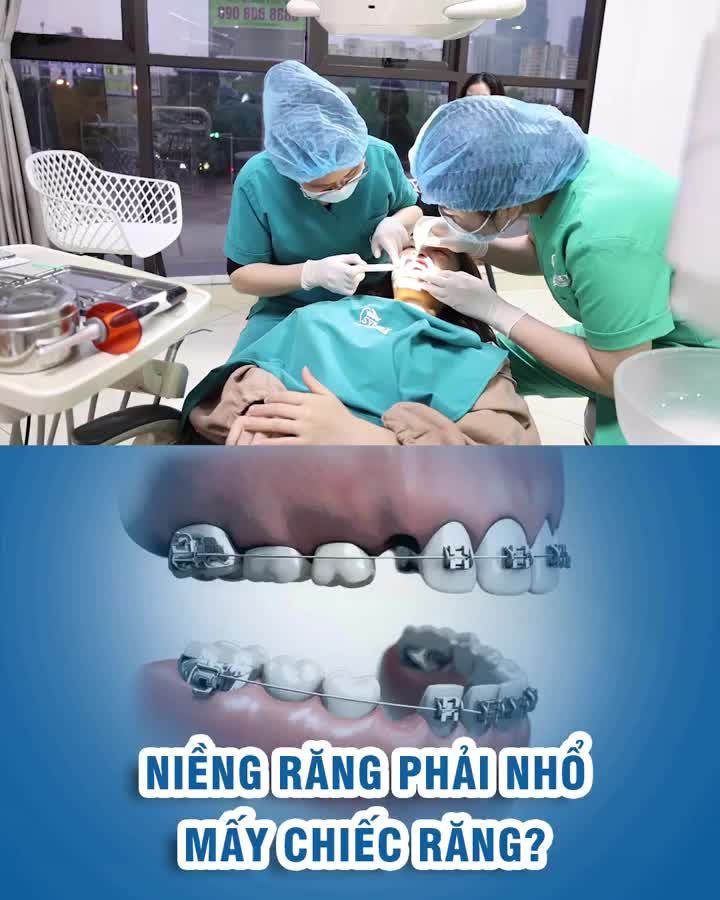 Niềng răng phải nhổ mấy chiếc răng?