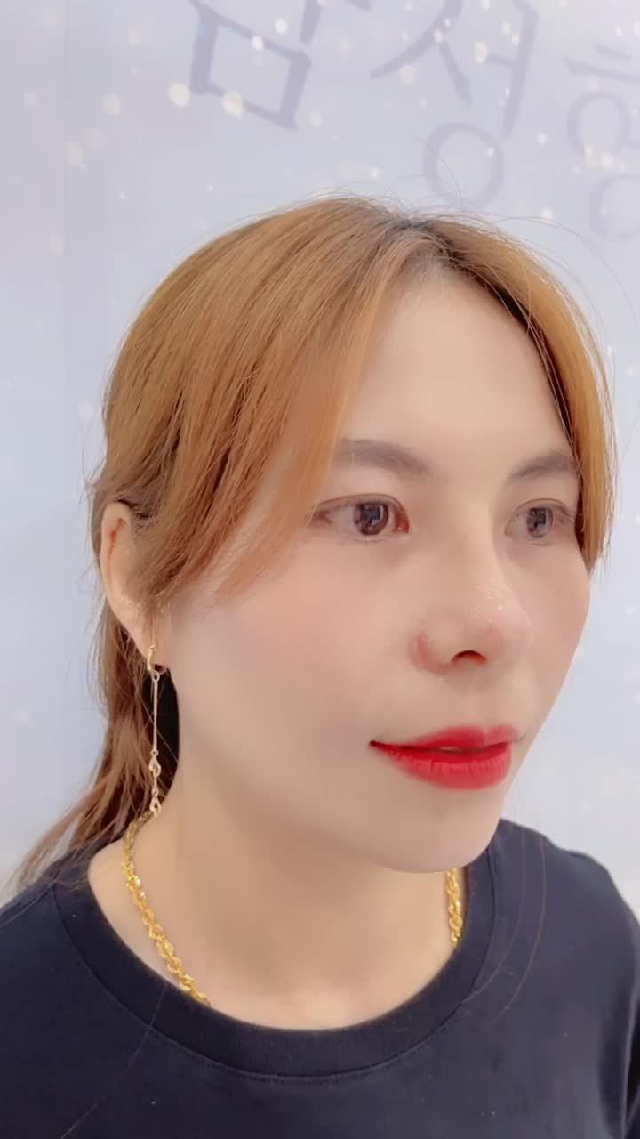 Kết quả Nâng mũi Sụn sườn sau 1 tháng - KH chia sẻ quá ƯNG Ý!