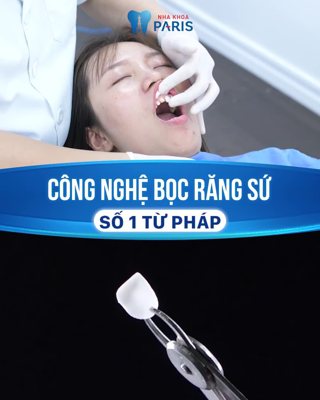 TẠM BIỆT RĂNG NHIỄM MÀU, LỆCH LẠC SAU 2 BUỔI