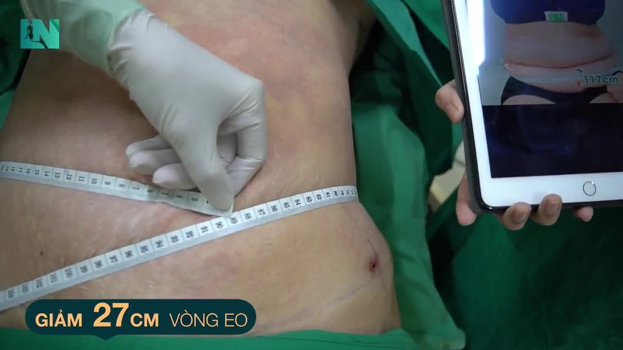 Sẽ thay đổi như thế nào sau ca  hút mỡ tạo dáng thẩm mỹ?