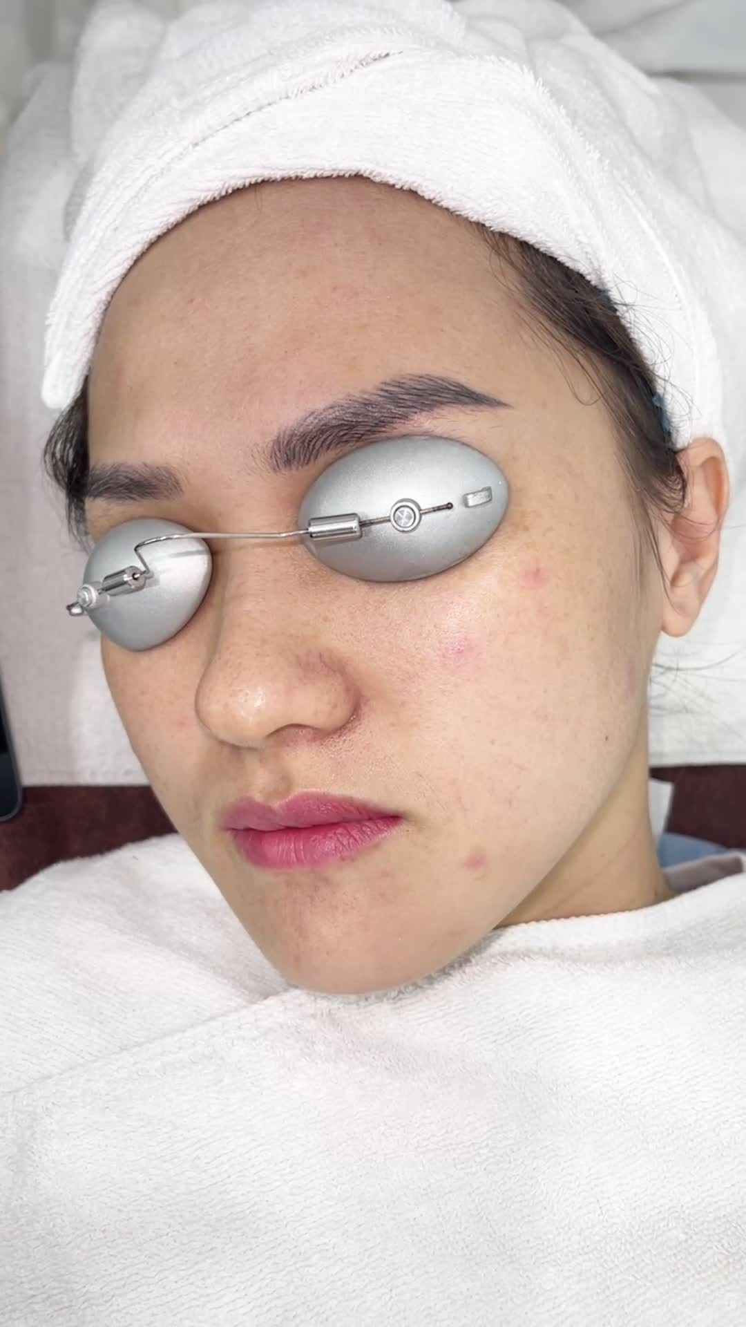 Xoá bay nám chỉ sau 1 liệu trình với công nghệ Laser Picosure