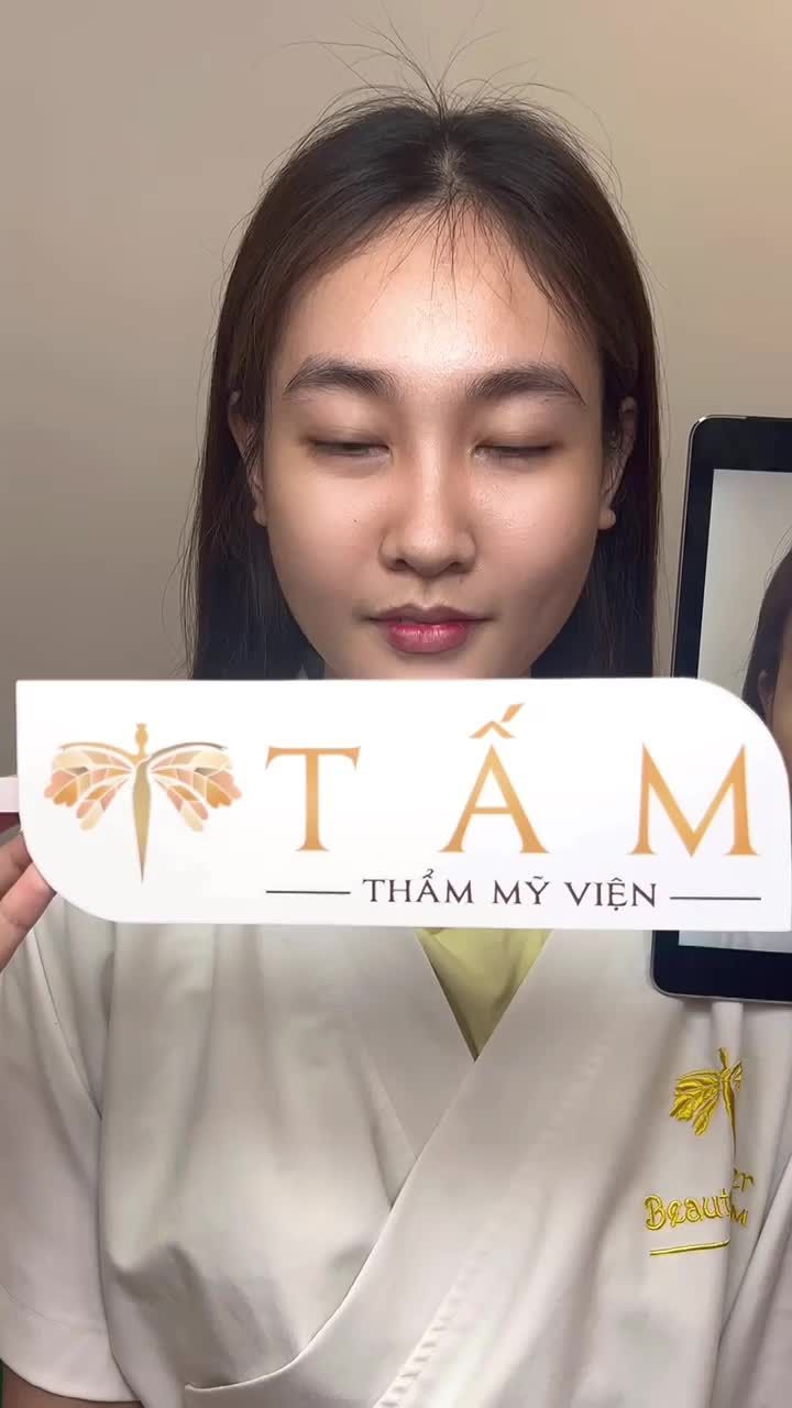 Ca cân chỉnh gương mặt nhờ combo Filler má, thái dương, môi.