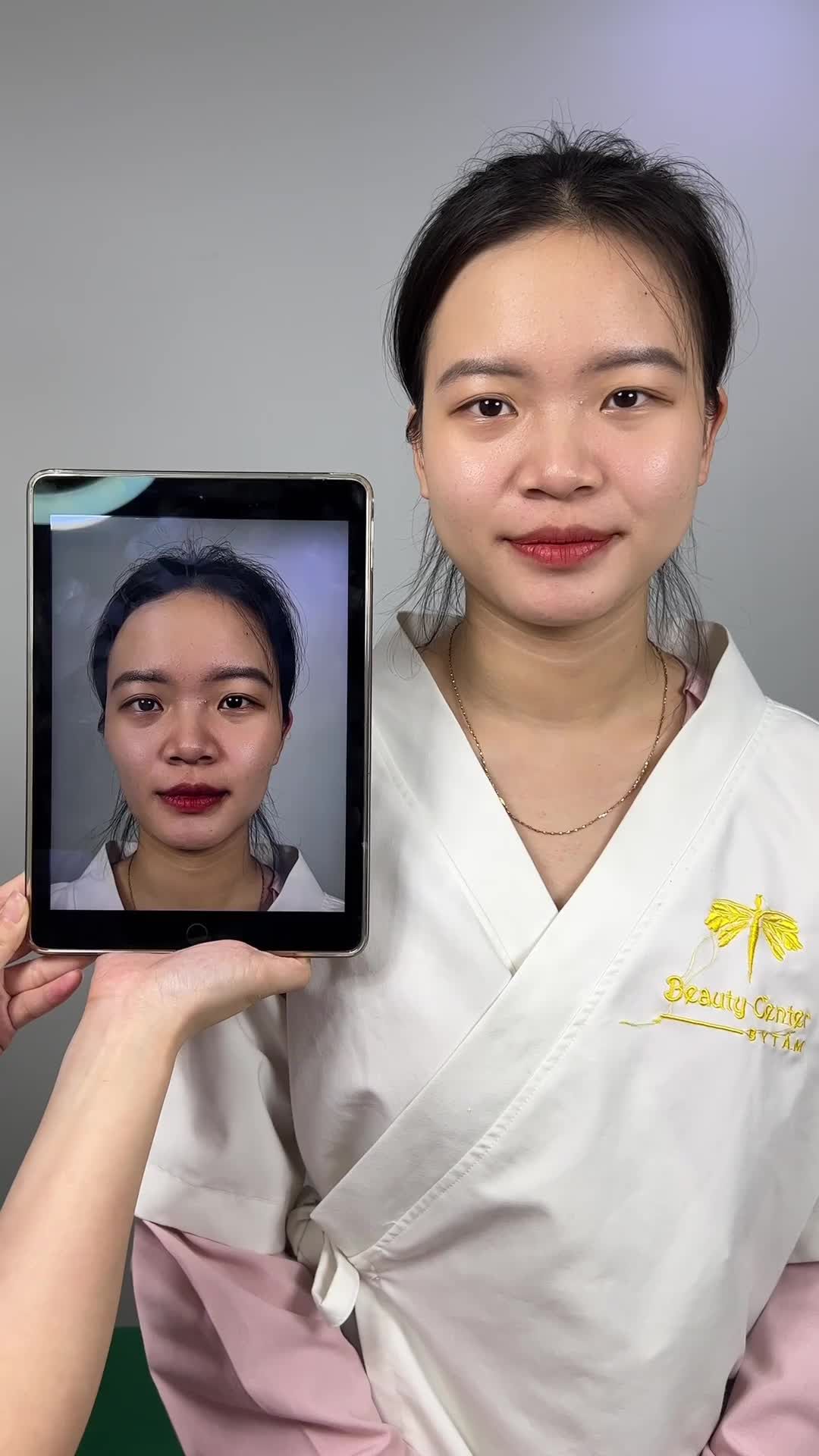 Ca filler má tại phòng khám thẩm mỹ viện Tấm. Bạn khách hàng sau khi làm dịch vụ đã có gương mặt tươi tắn, hài hoà hơn. Mọi người cùng theo dõi nhé.