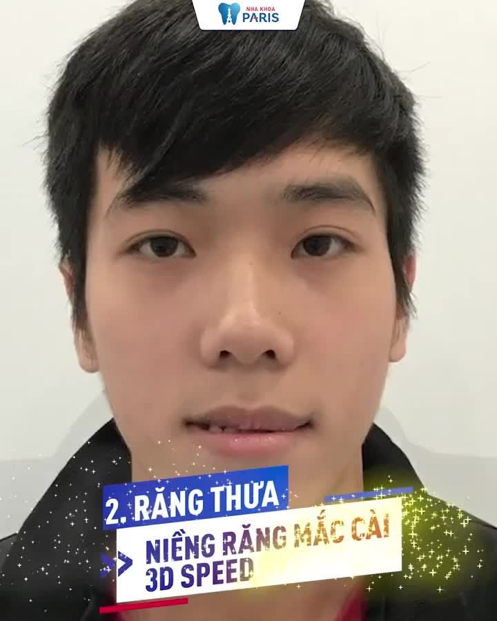 TOP 5 Case niềng răng thay đổi ngoạn mục
