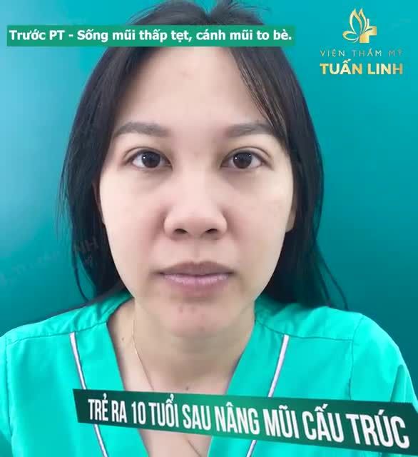 TRẺ RA 10 TUỔI SAU NÂNG MŨI?
