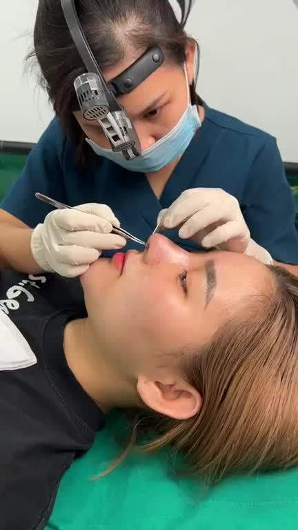 Mũi tái cấu trúc sụn Surgiform sau 10 ngày