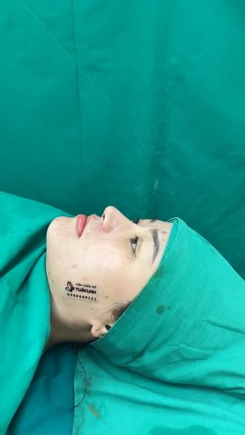 Case nâng mũi cấu trúc sụn Surgiorm
