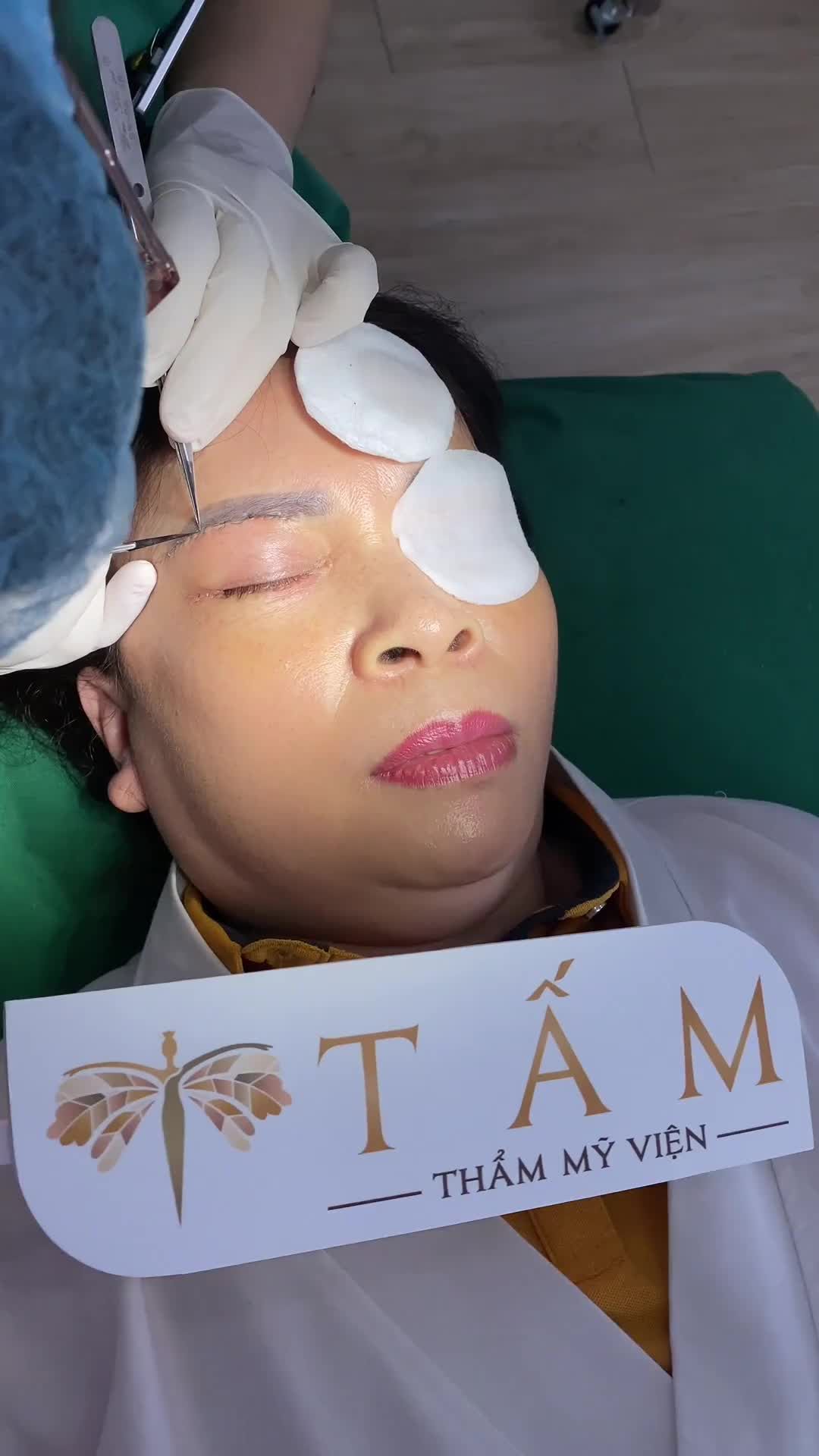 Khách hàng quay lại sau 6 ngày làm combo Nâng cung chân mày Cắt mí dưới, tình trạng sưng/tím được cải thiện rất nhiều!