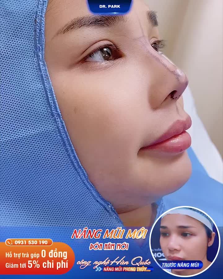 VÌ SAO ĐA SỐ BẠN NỮ THÍCH NÂNG MŨI?