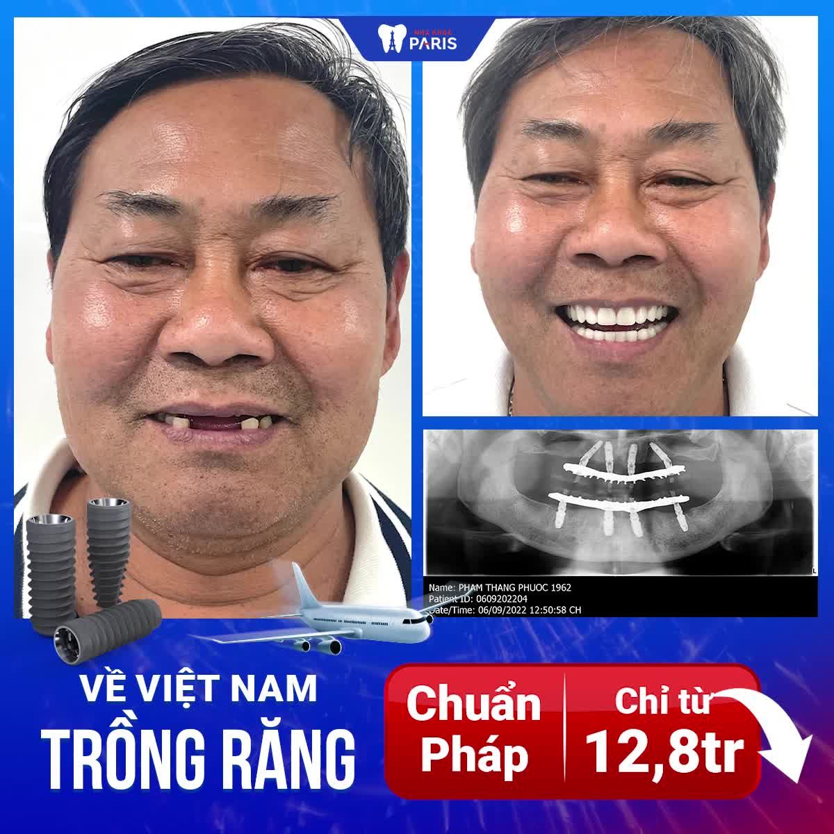 Về Việt Nam trồng răng-2 ngày kịp đón Tết