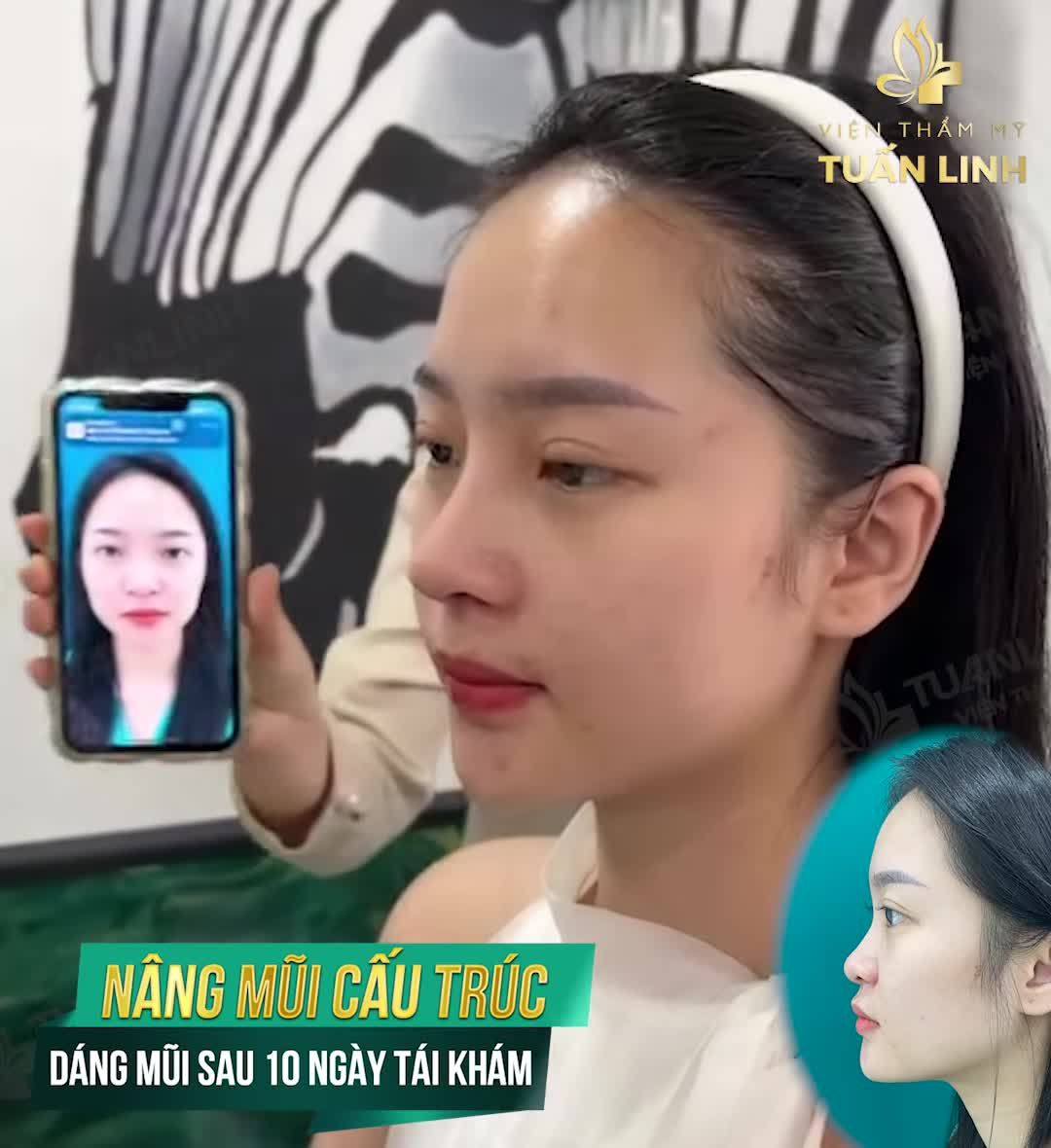 tái khám 10 ngày sau nâng mũi sụn tai